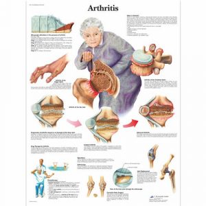 Arthritis and Osteoporosis Education