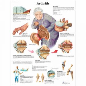 Arthritis and Osteoporosis Education