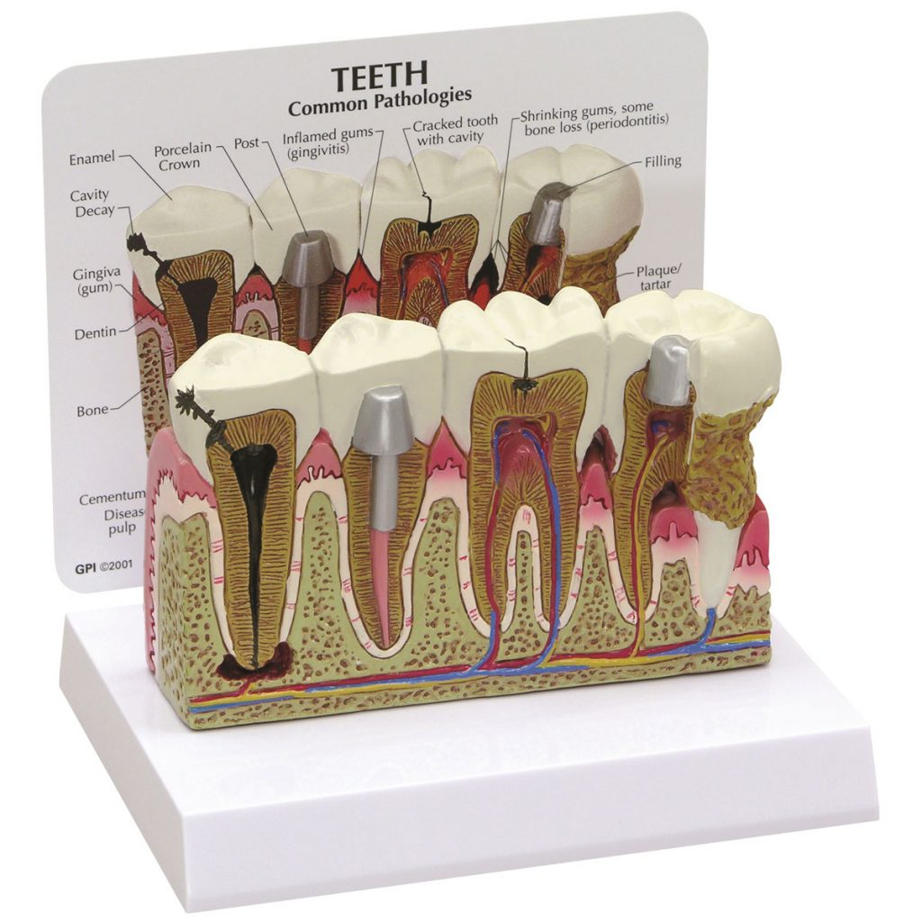 Comprehensive Lower Jaw Model (Left Half) with Diseased Teeth, Nerves ...