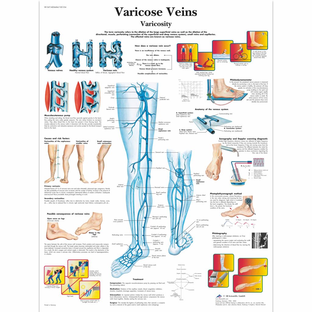 Varicose Vein Size Chart