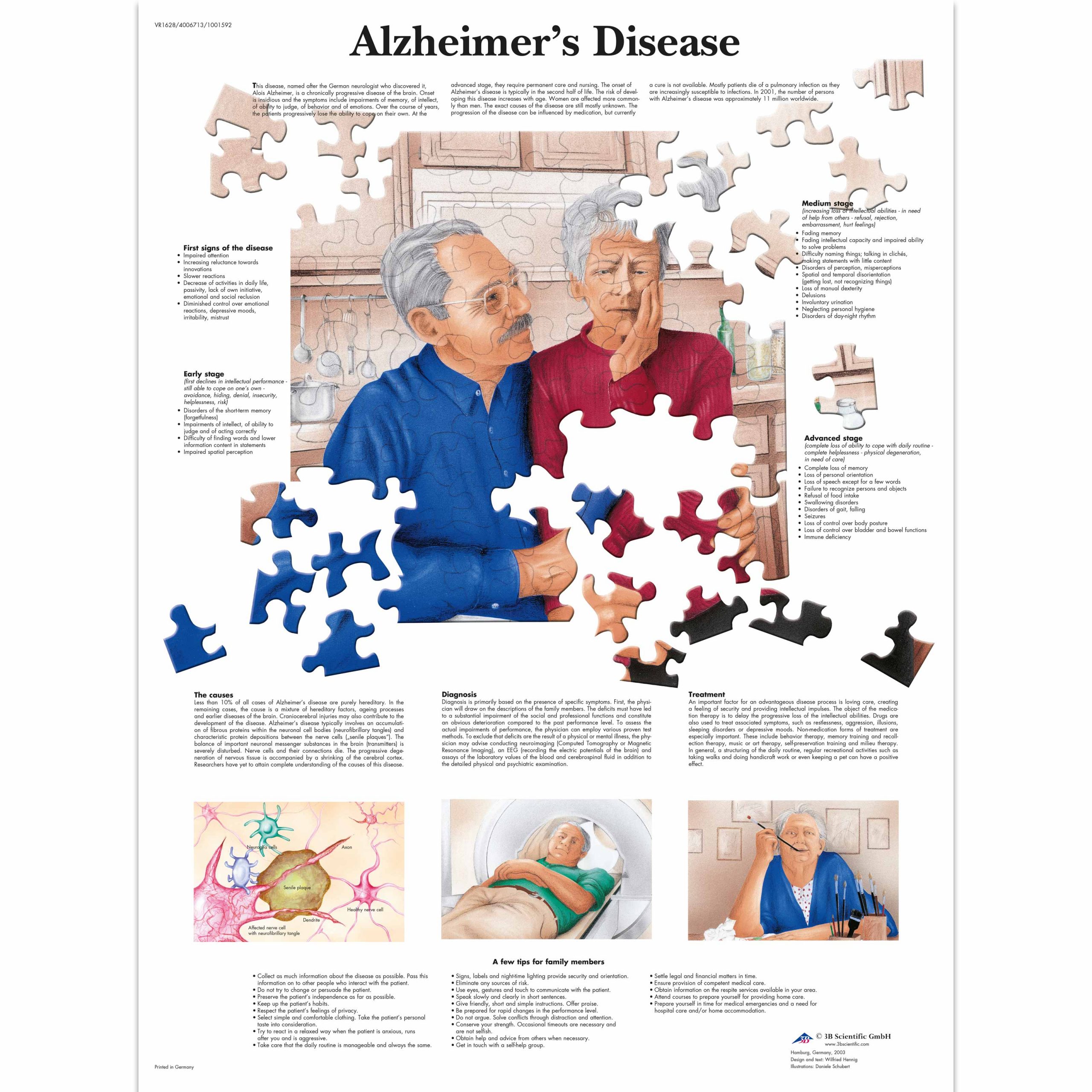 Alzheimer's Disease Stages Chart